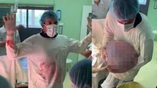 หญิงวัย 59 !!! ปวดท้อง หายใจไม่ออก ก่อนหมอพบ เนื้องอกหนัก 25 กก. ในรังไข่