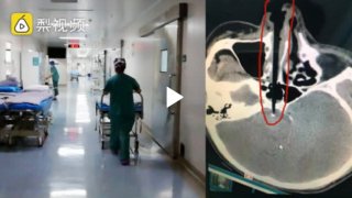 เกือบไม่รอด!! หนุ่มจีนเอาตะเกียบแคะจมูก ล้มหน้าคว่ำปักเข้ากะโหลก อาการหนัก