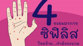 โรคซิฟิลิส