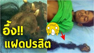 หมออึ้ง!! หนุ่มกินยังไงก็ไม่อิ่ม ปวดท้องหนัก เจอก้อนใหญ่แปลกในช่องท้อง