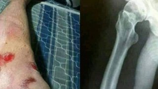 จยย.ล้มครับเพื่อนๆ ไปเอ็กซเรย์มาล่ะ หมอบอกไม่เป็นอะไรมาก