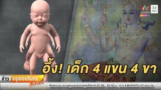 ผ่าคลอดทารกเพศหญิง 4 แขน 4 ขา หรือจะเป็น"นารายณ์อวตาร"!!!