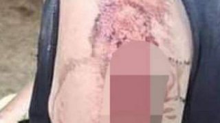 สยอง ยายถูกสุนัขสิบตัวรุมกัดที่เพชรบูรณ์ แผลเหวอะหว่ะทั่วร่าง