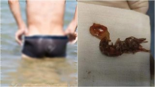 หมออึ้งหนัก!! เด็กชายวัย 14 เอากุ้งตัวเป็นๆ ยัดรูทวาร เลียนแบบรายการดัง