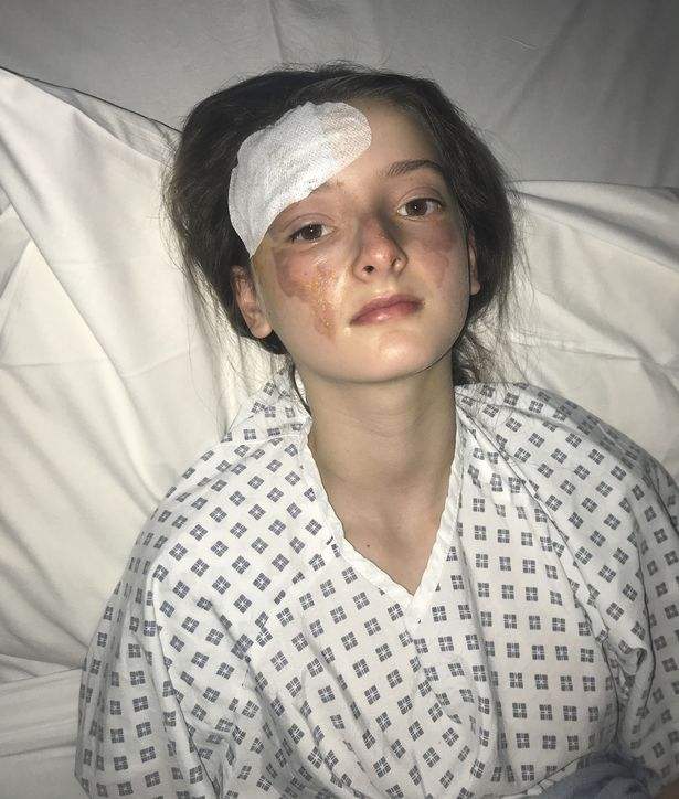 เด็กนักเรียนหญิง วัย 12 ปี ทนทุกข์ทรมานจากการถูกไฟลวกบนใบหน้าจากการลอง 'ลวก' ไข่ในไมโครเวฟเลียนแบบในรายการออนไลน์