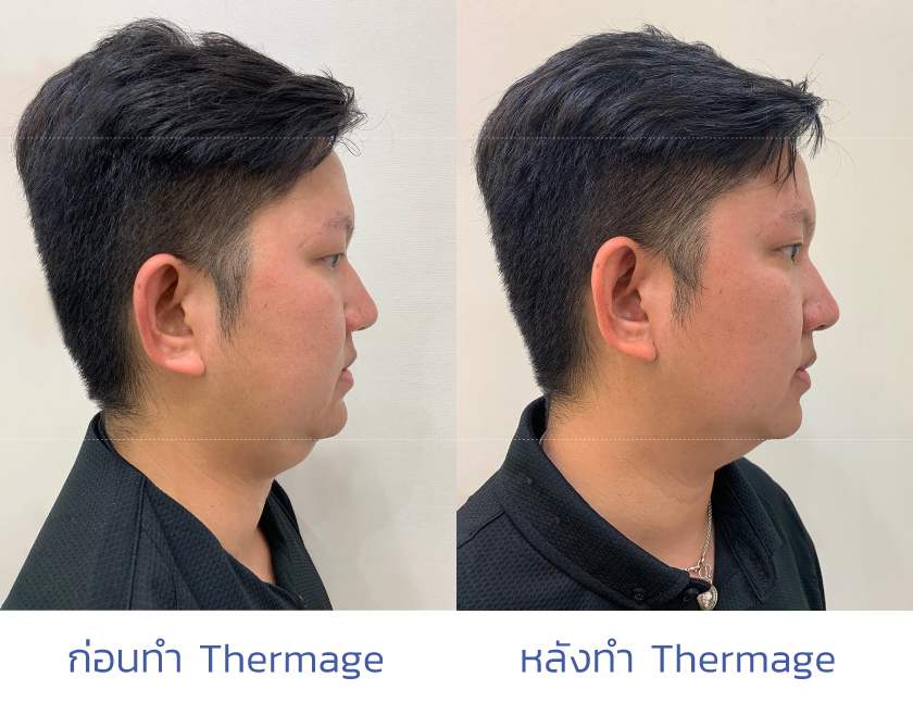 Thermage FLX คืออะไร? มีดีอย่างไร เมื่อเทียบกับวิธียกกระชับผิวแบบเดิม