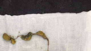 แพทย์ในอินเดียได้นำก้อนขนขนาดใหญ่ออกจากท้องของเด็กหญิงอายุ 5 ขวบ