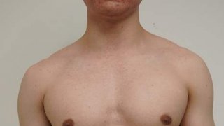 รีวิวดูดไขมันสร้าง Six Pack ปั้นซิกแพคสวยด้วยมือหมอ