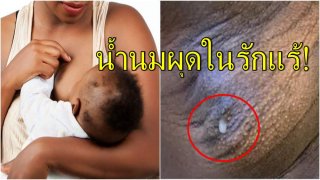 แปลกมาก! หญิงชาวโปรตุเกสมีน้ำนมผุดขึ้นจากรักแร้ หลังคลอดลูกได้ 2 วัน