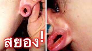สุดช็อค!สาวขอความเห็นใจ โชว์รูหูหมดสภาพ จากการโดนแฟนทำพิเรนทร์