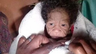 คุณแม่ยังสาวให้กำเนิดทารกที่ 'ดูแก่กว่าเธอ' เนื่องจากโรคที่หายาก