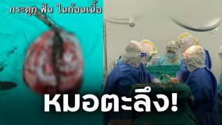 หมอตะลึง!! ผ่าท้องสาวพบเส้นผม เศษกระดูกอ่อน เล็บ และฟัน ผสมอยู่ ในก้อนเนื้อ