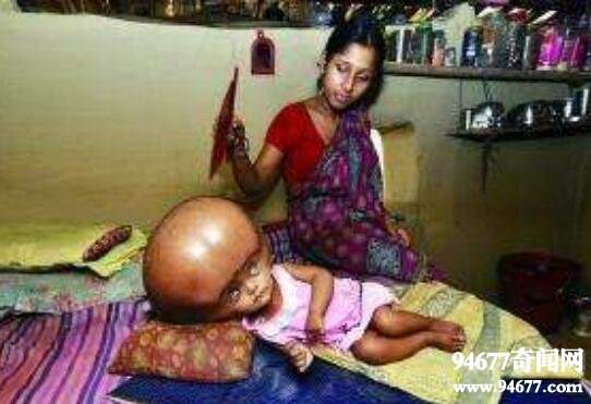 ทารกศีรษะโตที่สุดในโลก Lorna Begum เสียชีวิตแล้ว