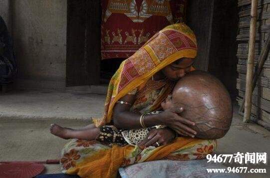ทารกศีรษะโตที่สุดในโลก Lorna Begum เสียชีวิตแล้ว
