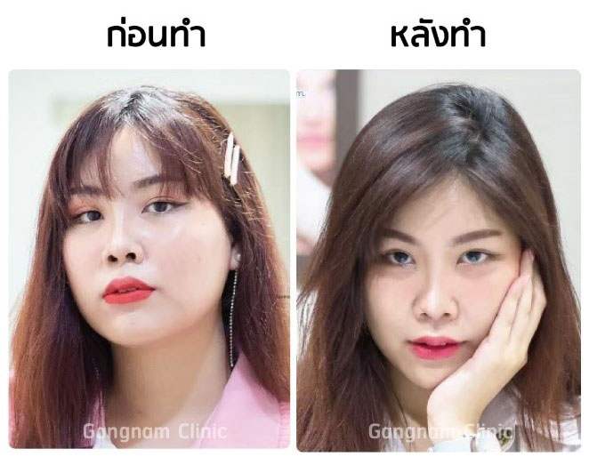 ฉีดเมโสหน้าใสช่วยเรื่องไหนบ้าง? ฉีดแล้วหน้าใสขึ้นจริงไหม? เป็นอันตรายหรือไม่?