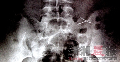 10月11日，湖南省儿童医院，小云（化名）的X光片清晰显示身体里残留的缝衣针。图/记者华剑