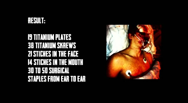 ขอบเขตของการบาดเจ็บของสวีเดนจะถูกเปิดเผยในตอนท้ายของวิดีโอ