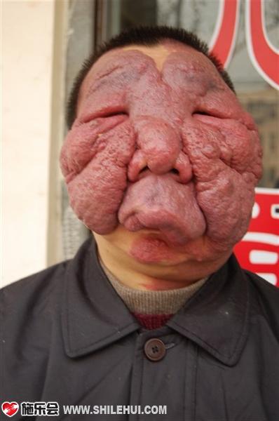 สลด! หนุ่มจีนป่วยแปลก ปานขึ้นเป็นดอกกะหล่ำเต็มหน้า