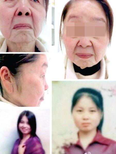 หญิงวัย 28 คลอดลูกแล้วหน้าแก่เท่า 80-90 ปี!!! ทันที (โรคประหลาด)