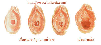 แนะนำแก้ปัญหาระบบภายในทั้งหลายของผู้หญิ้งผู้หญิง เข้ามาอ่านก่อนคะ