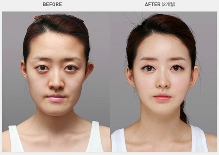 มาดูหนุ่ม สาวเกาหลีก่อน-หลัง ศัลยกรรม