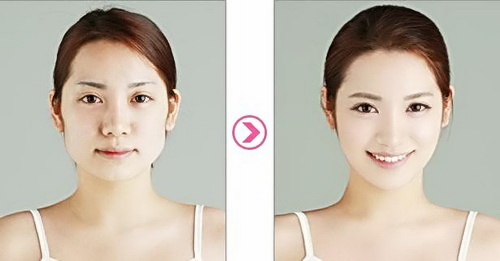 แพทย์เกาหลี เตือนศัลยกรรมหน้าเรียว (Double-jaw surgery) อันตรายกว่าที่คิด