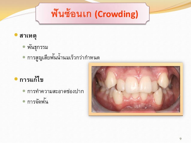 ฟันซ้อนเก น่ากลัวมาก