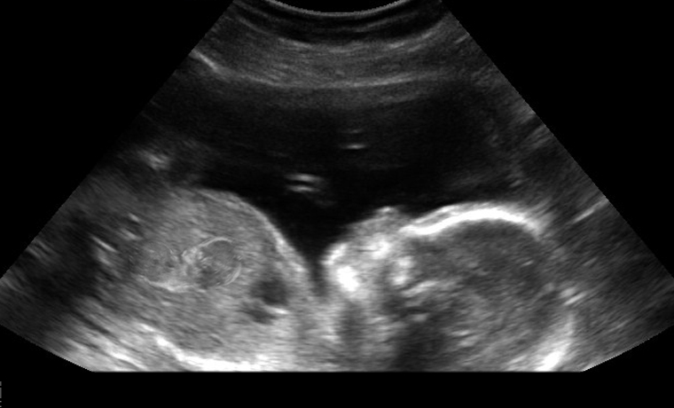 Empire-News-Unborn-Baby-Becomes-Pregnant-While-Still-In-The-Womb