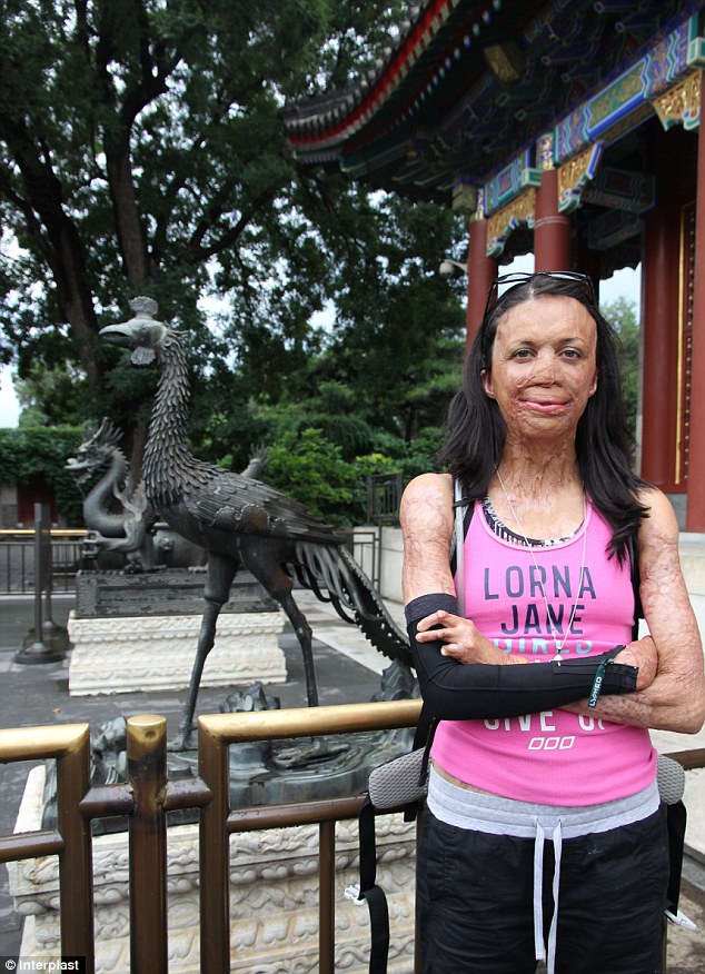 Turia Pitt trekked almost 95 kilometres across the Great Wall of China with 22 other women to raise money for the charity Interplast