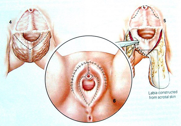 ศัลยกรรมผ่าตัด แปลงเพศ