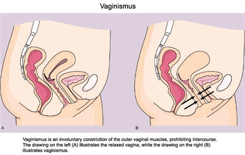 vaginismus causes
