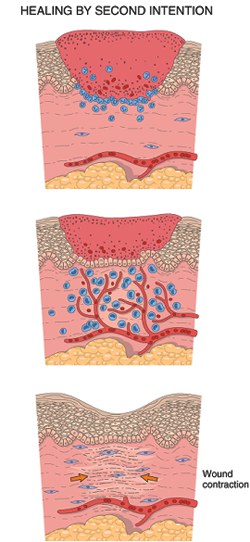 การหายของแผลแบบทุติยภูมิ