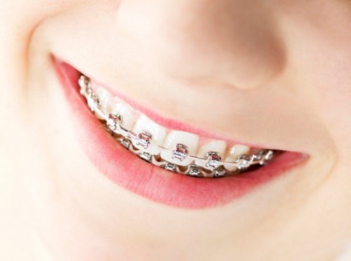 Metal-Braces-1-700x521