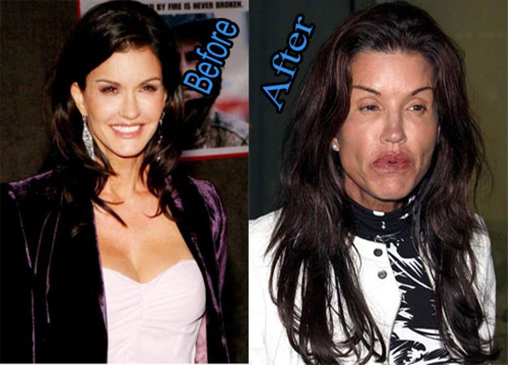 Janice-Dickinson-Plastic-Surgery