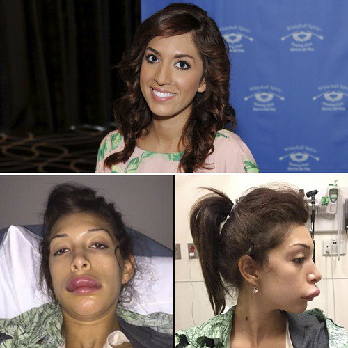 Farrah Abraham Plastic Surgery