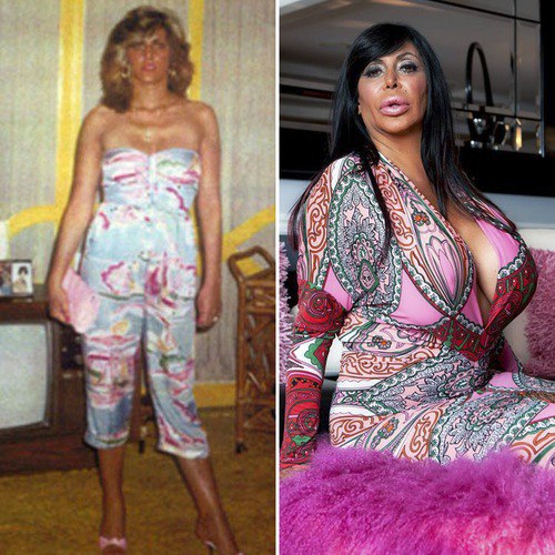 Big Ang Plastic Surgery