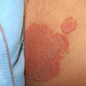 สังคังในผู้หญิง