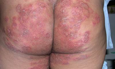 อาการของโรคสังคัง