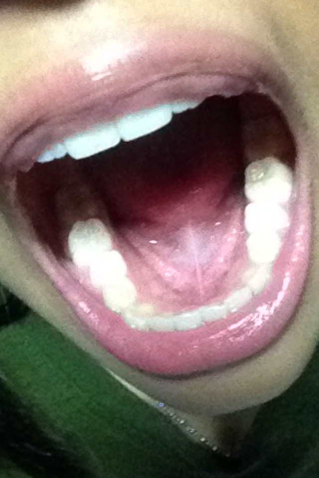 ฟันแบบนี้ดัดได้ไหม เราไม่ค่อยพอใจ หมอจะรับดัดไหม(มีรูป)