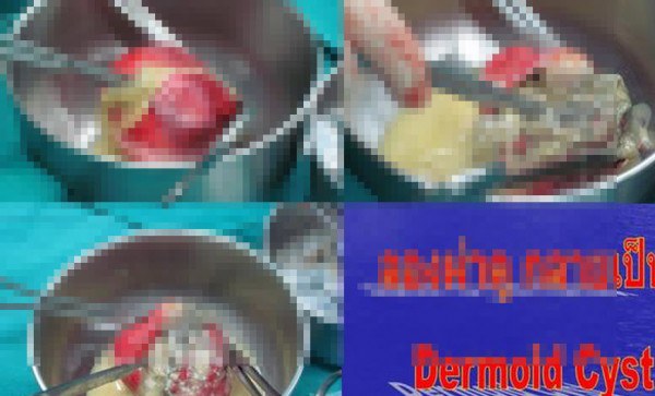 สาวไทยคนนี้ปวดท้อง ประจำเดือนมาไม่ปกติ  พอหมอผ่าข้างใน ถึงกับช็อคในสิ่งที่อยู่ในก้อนเนื้อของเธอ