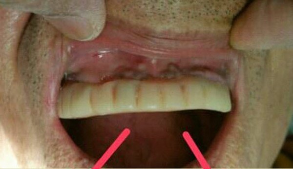 ลุงคนนี้ อ้าปากได้น้อย มีกลิ่นปากรุนแรง แต่พอหมอฟันตรวจดูก็ถึงกับช็อก ระวังกันด้วย