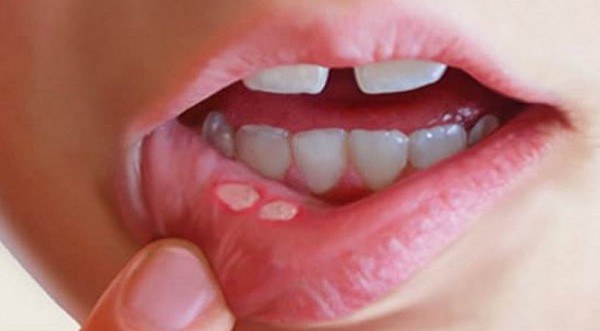 เหลือเชื่อ! วิธีแก้อาการเจ็บแผลในปากให้หายขาด ผลที่ได้แม้แต่หลายคนยังไม่สามารถอธิบายได้