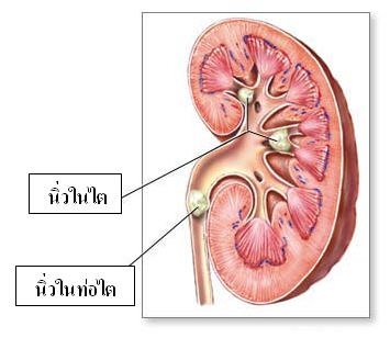 กรดไหลย้อนalgycon