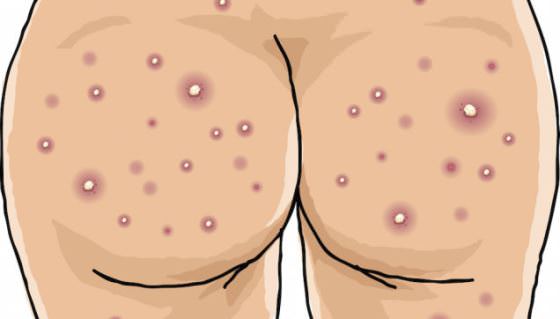 How-to-Cure-Acne-on-Buttocks