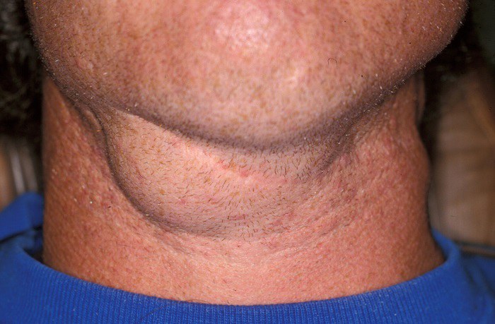 swollen-neck