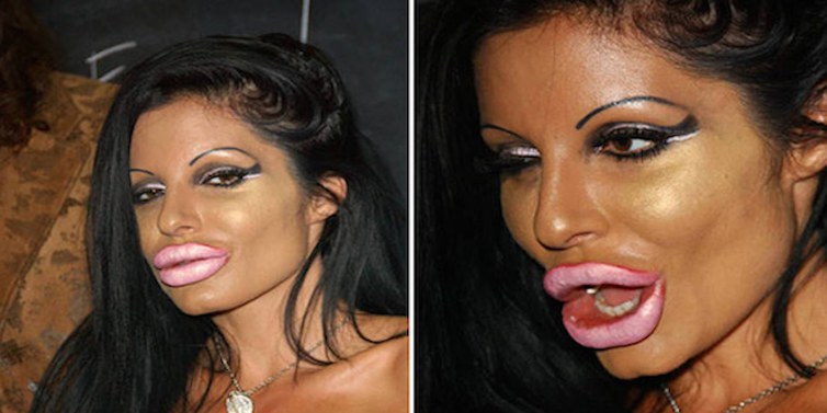 Priscilla Caputo looks like a fish, the lips started having lumps as seen here.