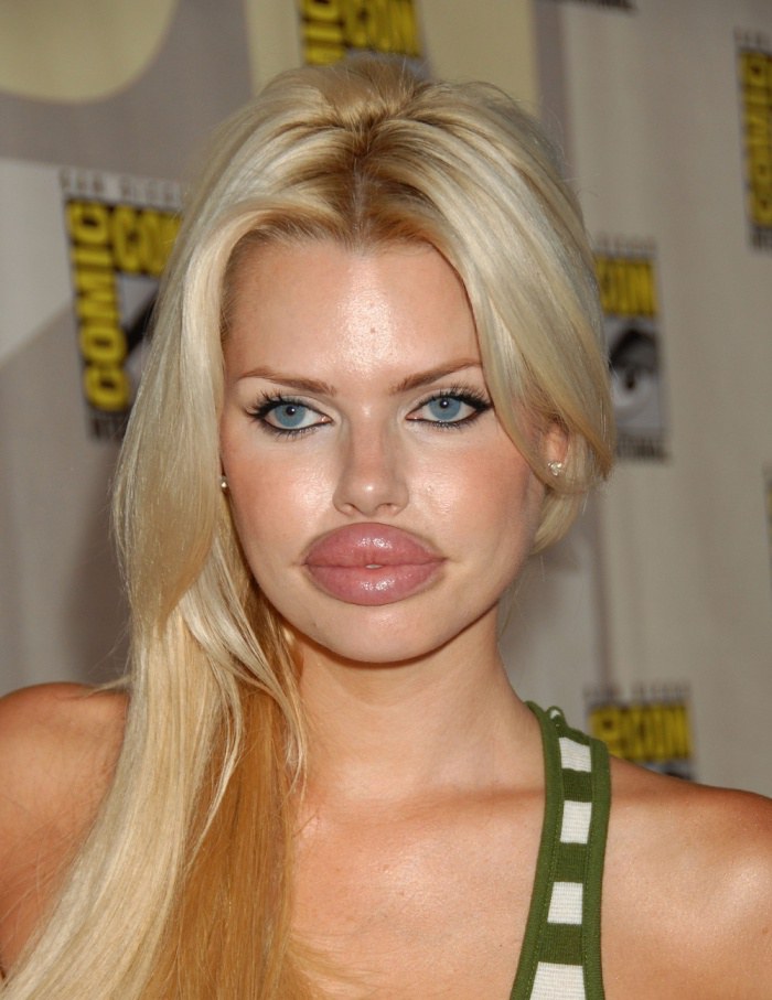 This girl could have been a bombshell without doing this filling to her lips.