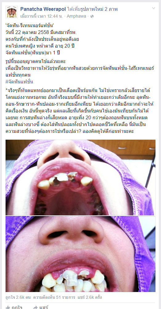 สยอง!! สาวสวยวัย 20 ต้องถอนฟันเกือบหมดปาก เพราะจัดฟัน-รีเทนเนอร์ราคาถูก