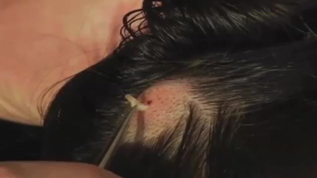 3. Larva found in a man's head.